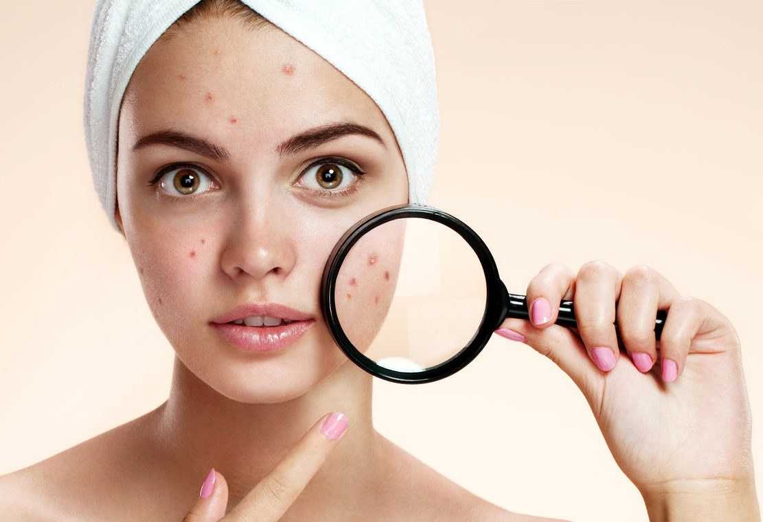 Buy Acne Treatment Online | Acne Medication & Pill | Daily Chemist