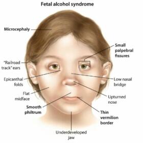 Fetal Alcohol Syndrome: Symptoms, Causes, Diagnosis, Treatment and More ...