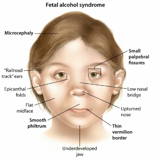 Fetal Alcohol Syndrome: Symptoms, Causes, Diagnosis, Treatment