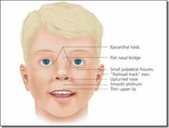 Fetal Alcohol Syndrome: Symptoms, Causes, Diagnosis, Treatment