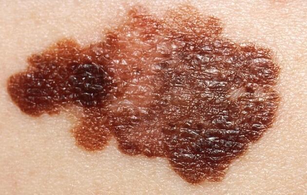 melanoma