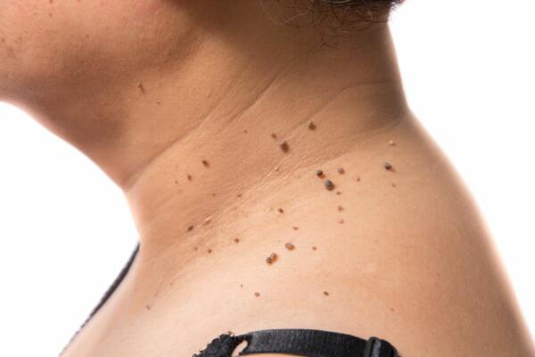 melanoma-symptoms-causes-risk-factors-prevention-and-more-daily